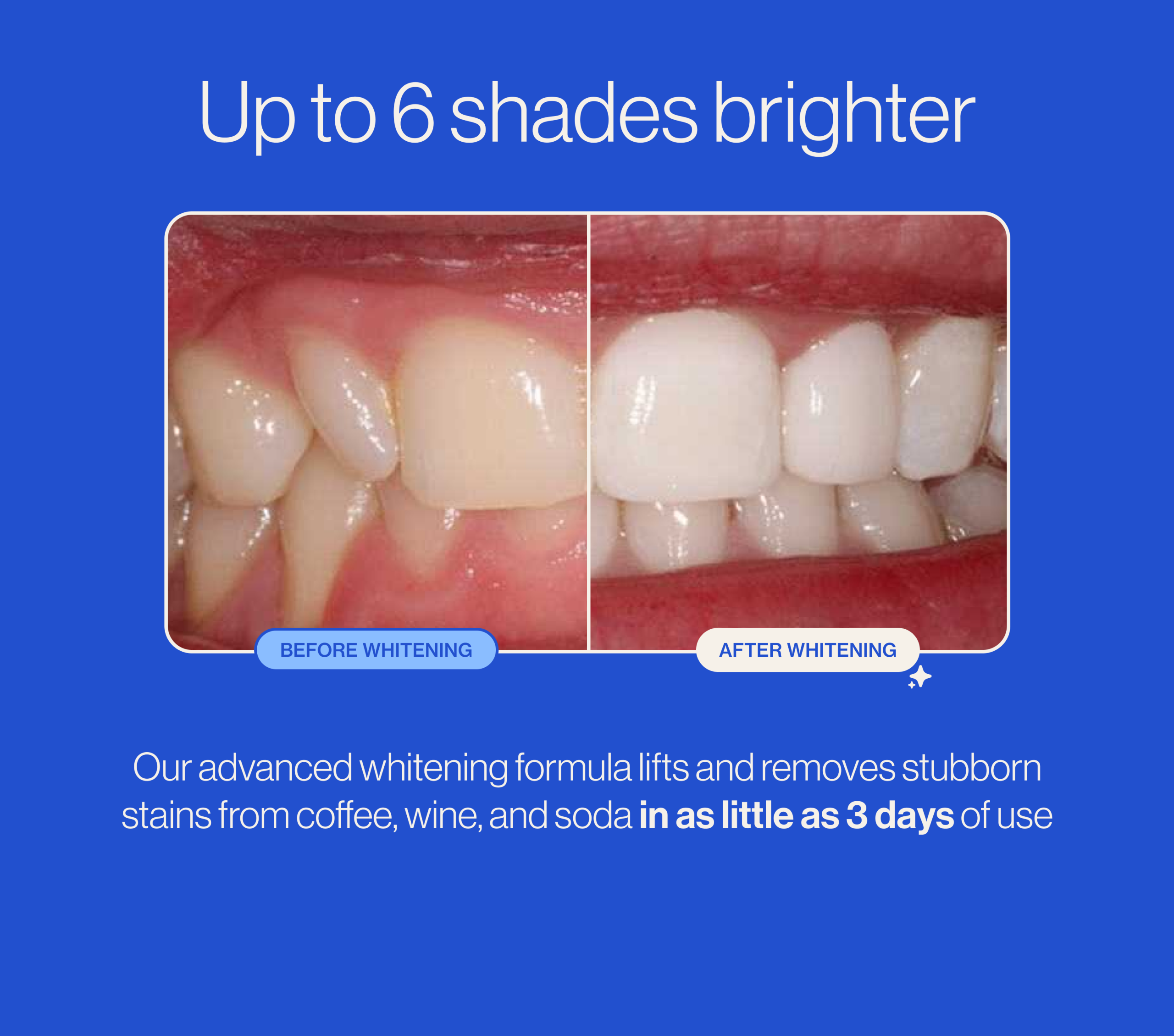 Autobrush® Whitening Tray - Image 2